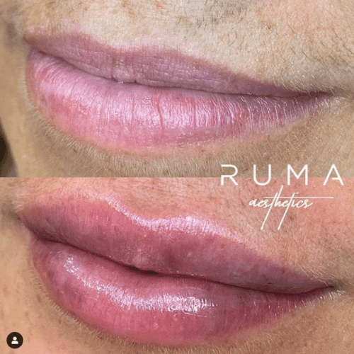 Lip fillers | RUMA Aesthetics