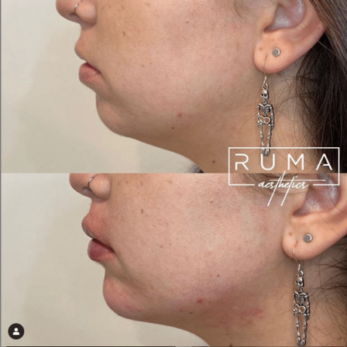 Before and After Images | RUMA Aesthetics
