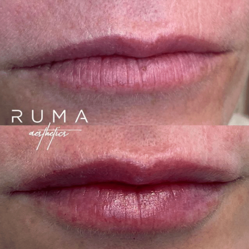 lip filler Before and After Images