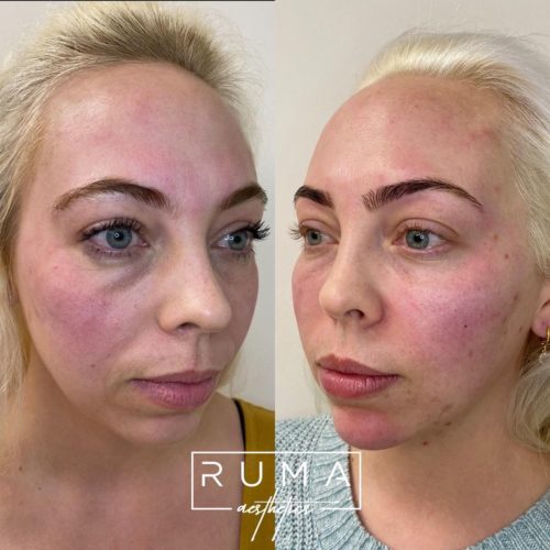 Chin Before and After Images | RUMA Aesthetics