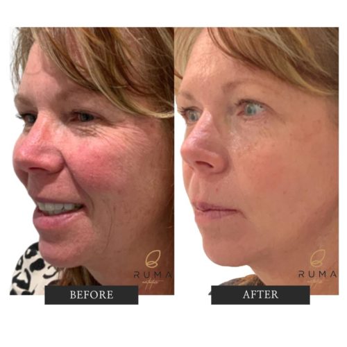 Vivace Facial Before and After Images