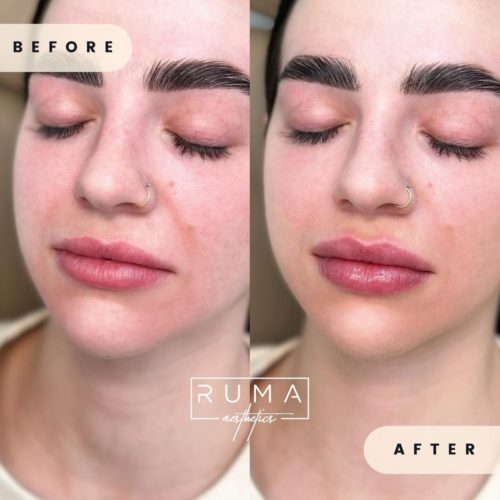 before-and-after-images-Fifty-two-UT-Ruma_Aesthetics