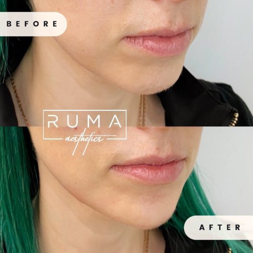 before-and-after-images-Forty-UT-Ruma_Aesthetics