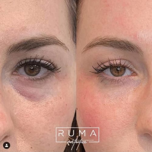 Before and After Images-UT -Ruma Aesthetic
