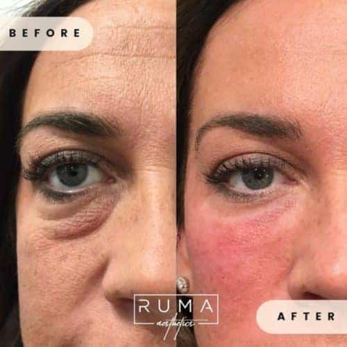 Signature Treatment before and after images | Ruma Aesthetics