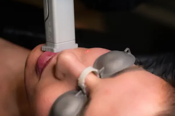 Helix Laser Resurfacing