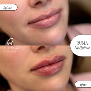 Fillers BeforeandAfter Ruma2 600x600 1