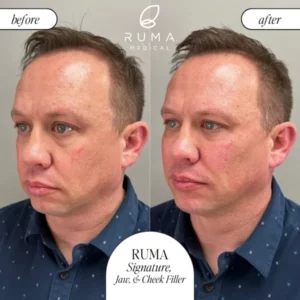 Fillers BeforeandAfter Ruma3 600x600 1