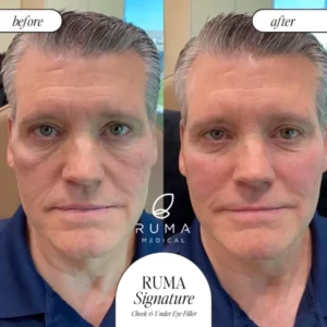Fillers BeforeandAfter Ruma5 600x600 1