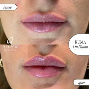 Fillers BeforeandAfter Ruma7 600x600 1