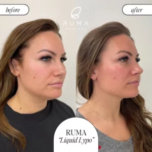 Kybella BeforeandAfter Ruma 600x600 1
