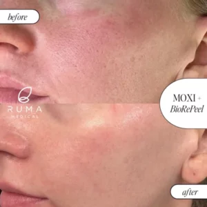 LaserTreatments BeforeandAfter Ruma 600x600 1