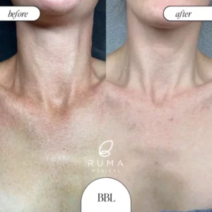 LaserTreatments BeforeandAfter Ruma2 600x600 copy