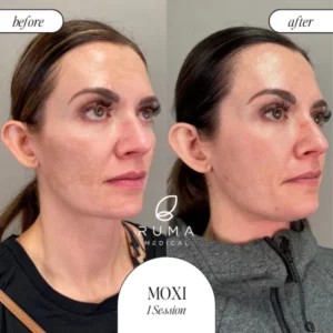 LaserTreatments BeforeandAfter Ruma3 600x600 1