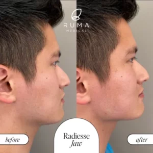 Sculptra BeforeandAfter Ruma 600x600 1