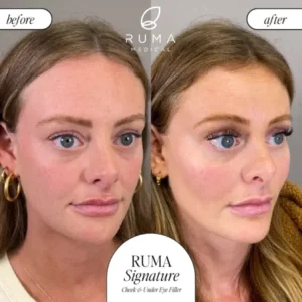 Fillers before & after