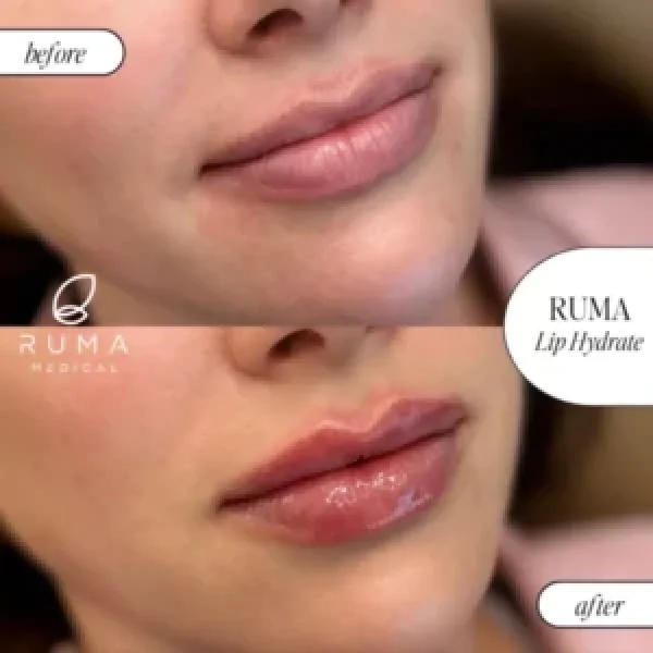 Fillers before & after
