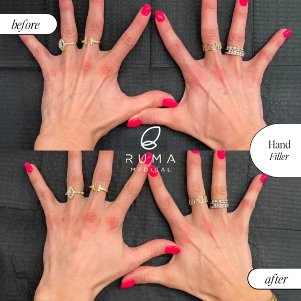 Fillers before & after