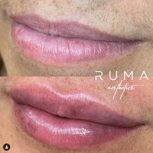 Lip fillers | RUMA Aesthetics