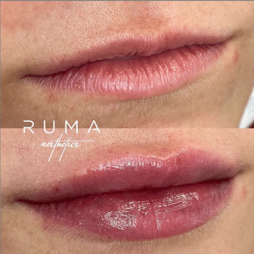 Before and After Images lip filler | RUMA Aesthetics