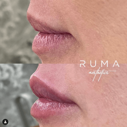 Lip fillers | Before and After Images | Lehi, UT | RUMA Aesthetics