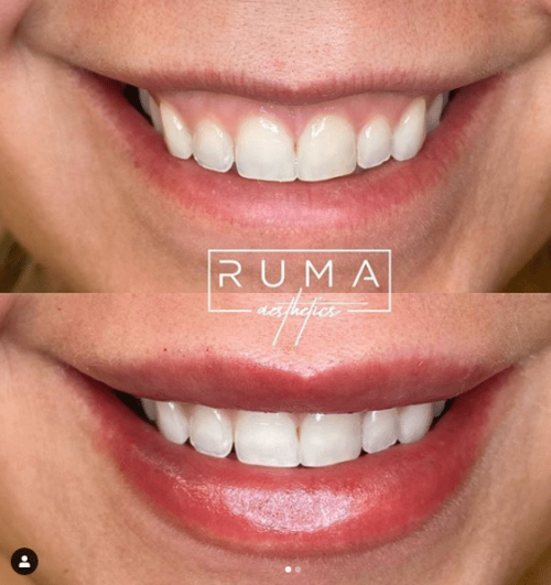 lip filler | RUMA Aesthetics