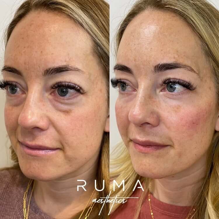 THE RUMA SIGNATURE TREATMENT