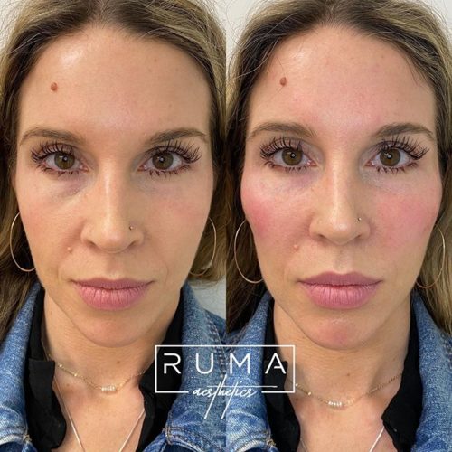 Signature Tear Trough Cheek Filler