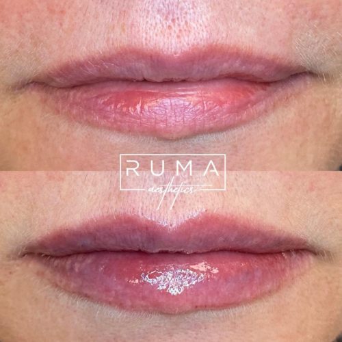 Lip Fillers Before and After Images