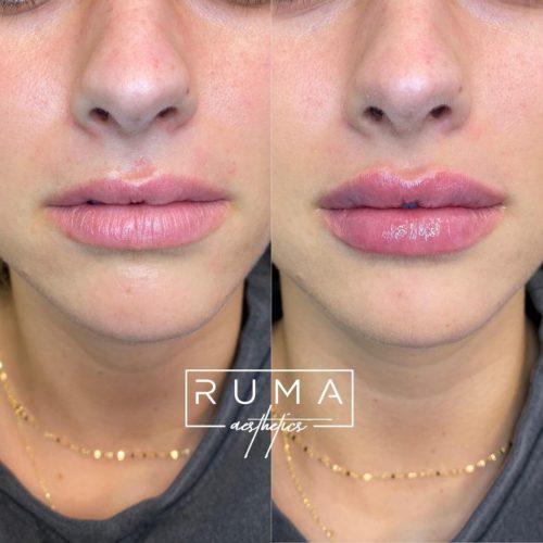 Lip Filler | RUMA Aesthetics