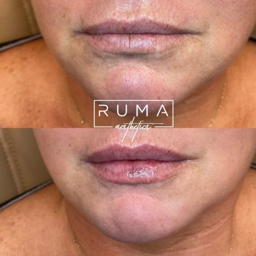 Lip Hydrate | RUMA Aesthetics
