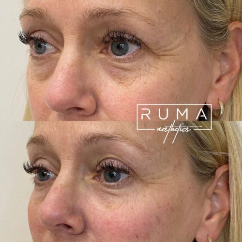 Signature Tear Before & After