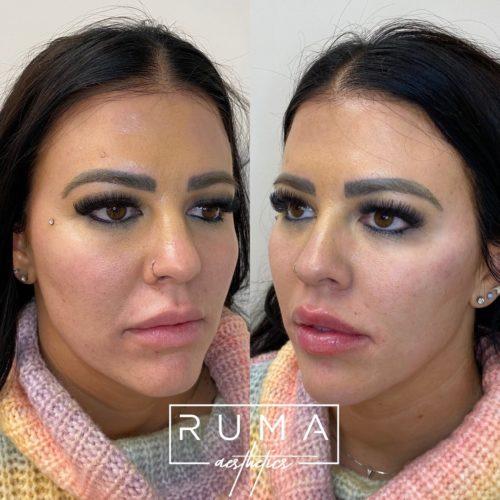 Lip Filler Before and After Images | RUMA Aesthetics