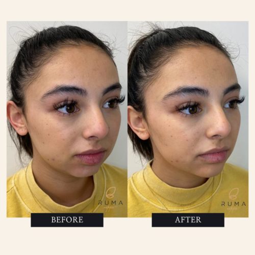 Chin Filler Before and After Images | RUMA Aesthetics