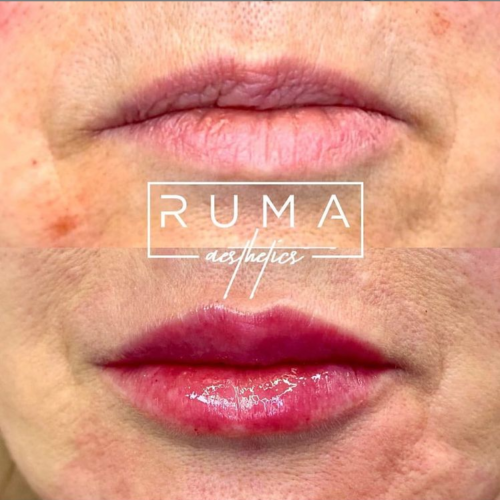 Before-and-After-Picture-Ruma-UT-Ruma-Aesthetics