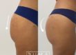 Butt lift with PDO threads | UT-RUMA Aesthetics