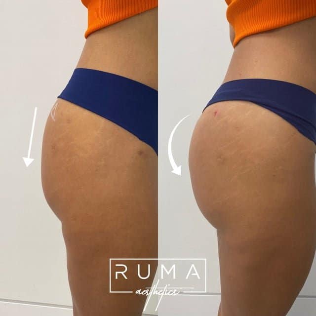 Butt lift with PDO threads | UT-RUMA Aesthetics