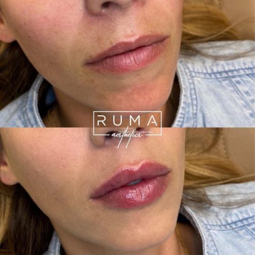 Lip Enhancement Before and After Photos