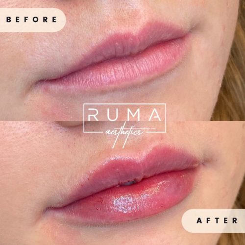 lip fillers - Ruma Aesthetic