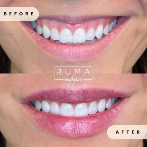 before-and-after-images-Forty-three-UT-Ruma_Aesthetics