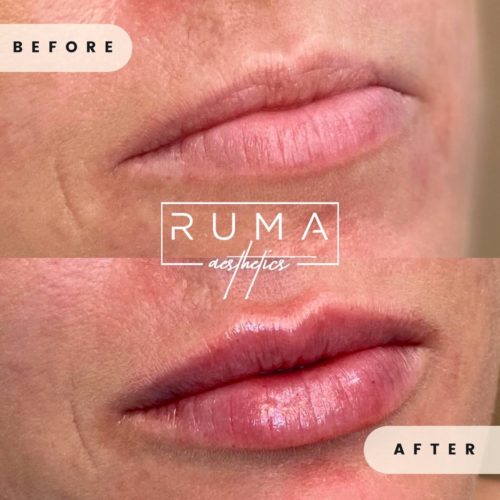 before-and-after-images-Forty-Five-UT-Ruma_Aesthetics