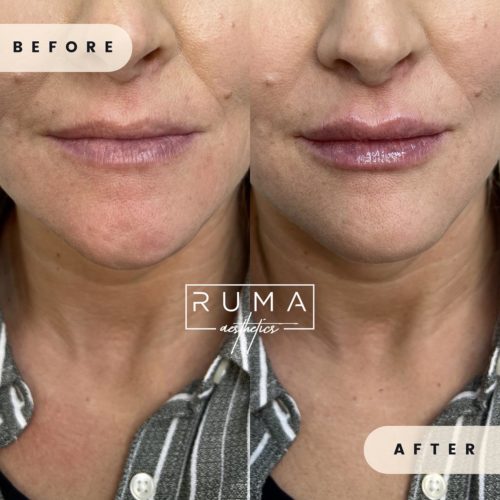 before-and-after-images-Forty-nine-UT-Ruma_Aesthetics