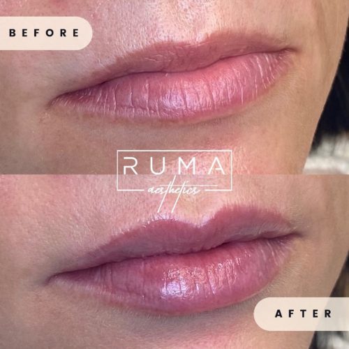 before-and-after-images-Forty-one-UT-Ruma_Aesthetics