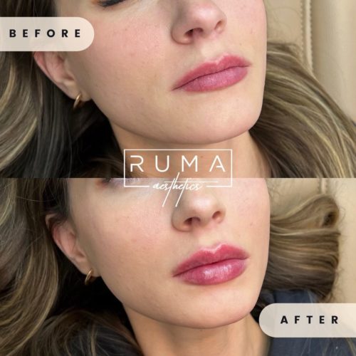 before-and-after-images-Forty-seven-UT-Ruma_Aesthetics