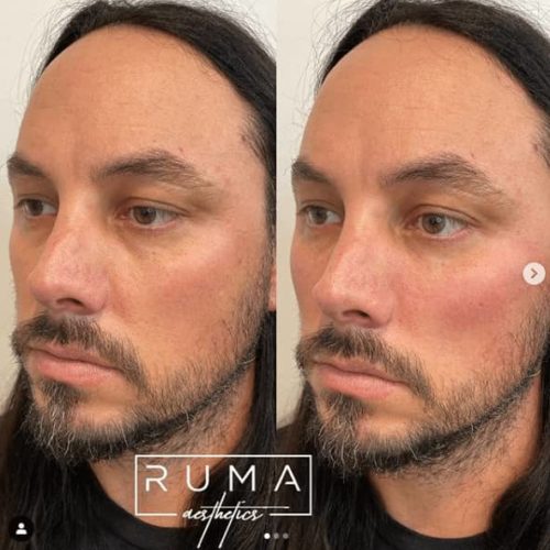 Before and After Images-UT -Ruma Aestheti- Twelve
