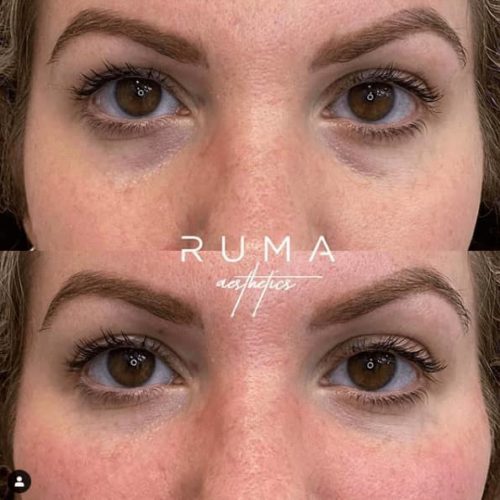 Before and After Images Signature Tear Through and Cheeck Filler-UT-Ruma Aesthetics
