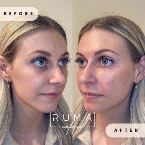 before-and-after-Sixty-two-UT-Ruma_Aesthetics