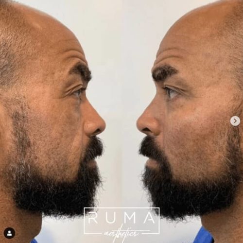 Before and After Images -UT -Ruma Aesthetic Six