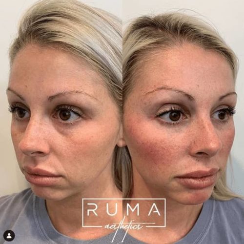 Before and After Images-UT -Ruma Aesthetic Eleven
