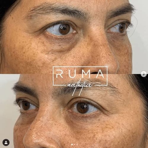 Before and After Images-UT -Ruma Aesthetic Ten